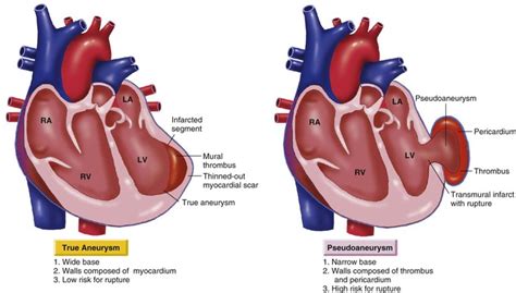 lv apical aneurysm vs pseudoaneurysm|Lv aneurysm anticoagulation.